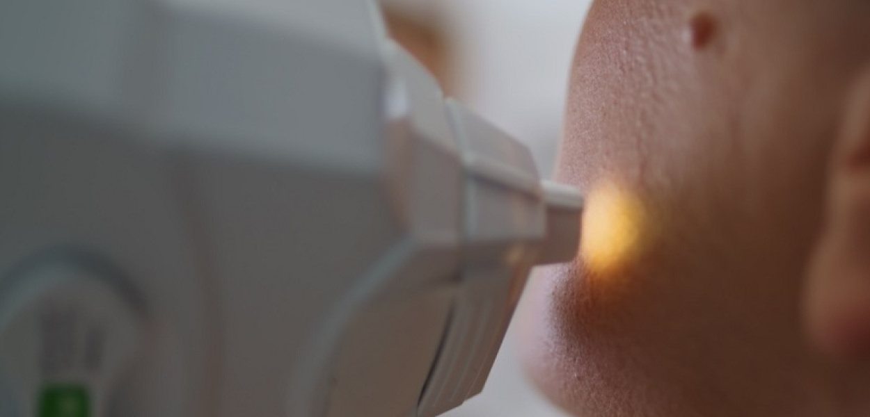 Laserowe zamykanie naczynek - sposób na rumień i pajączki na twarzy